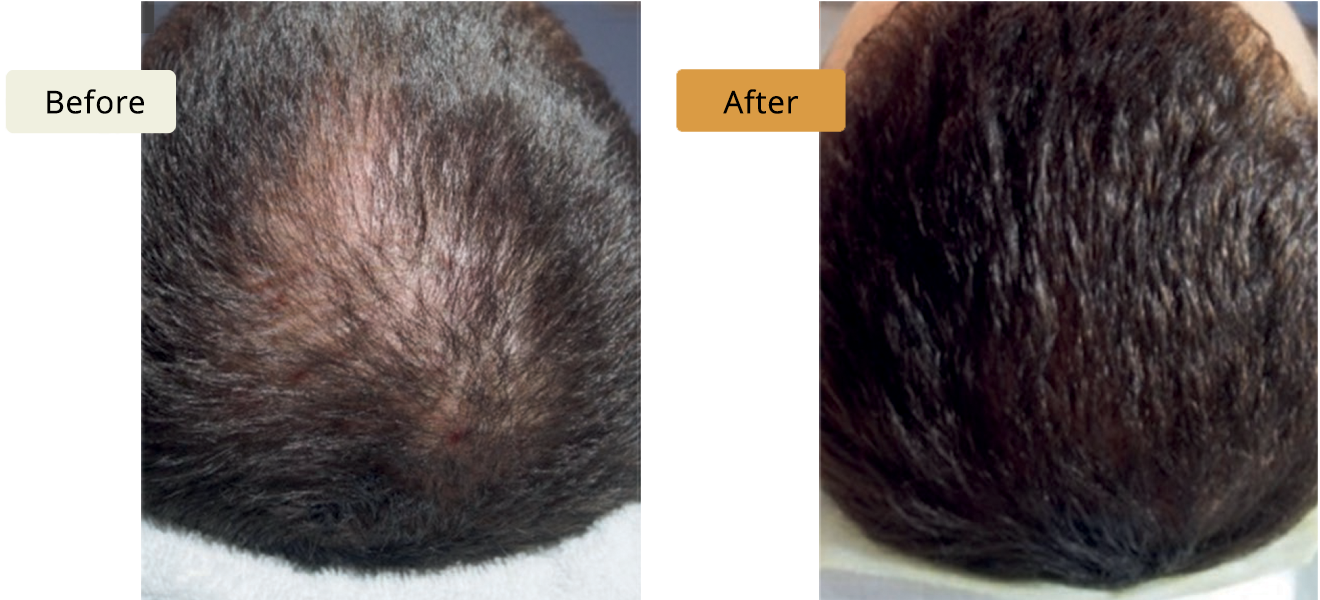 ELE'VI Skin & Medical Aesthetics hair restoration result — Omaha, NE