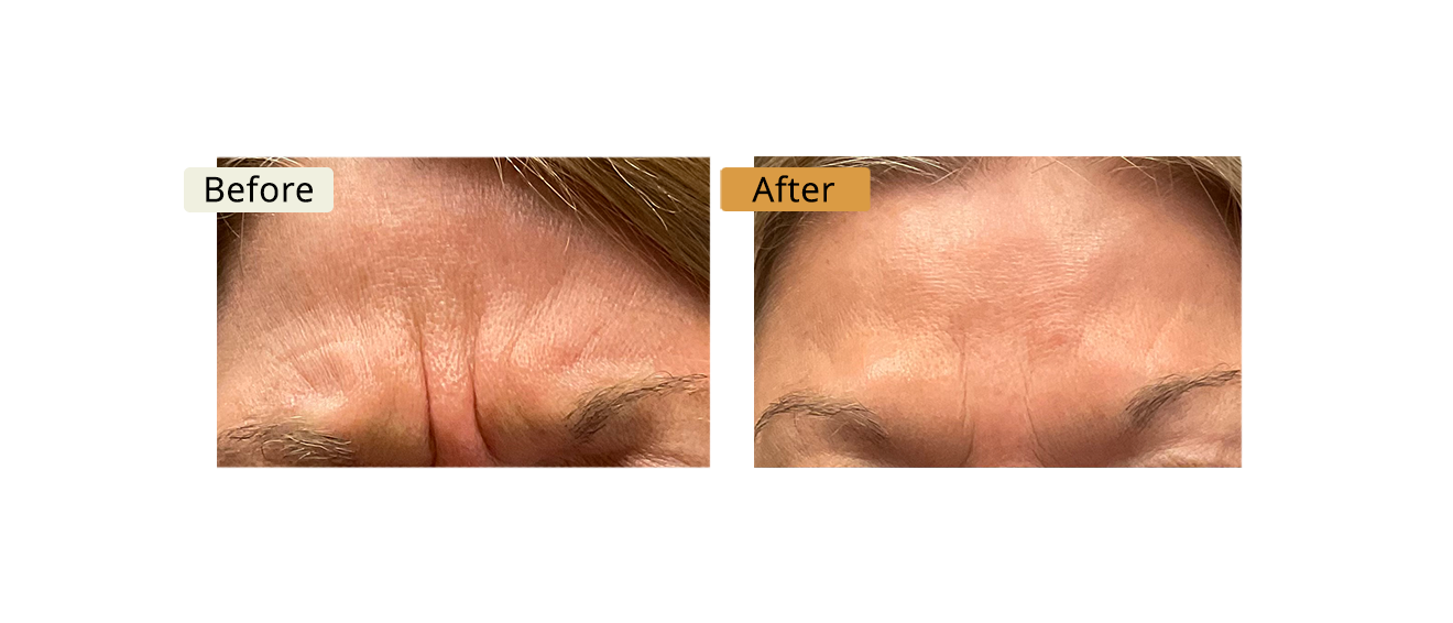 ELE'VI Skin & Medical Aesthetics botox result — Omaha, NE