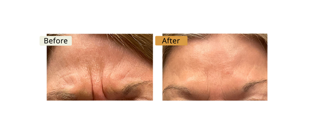 Botox result at ELE'VI Skin & Medical Aesthetics in Omaha, NE