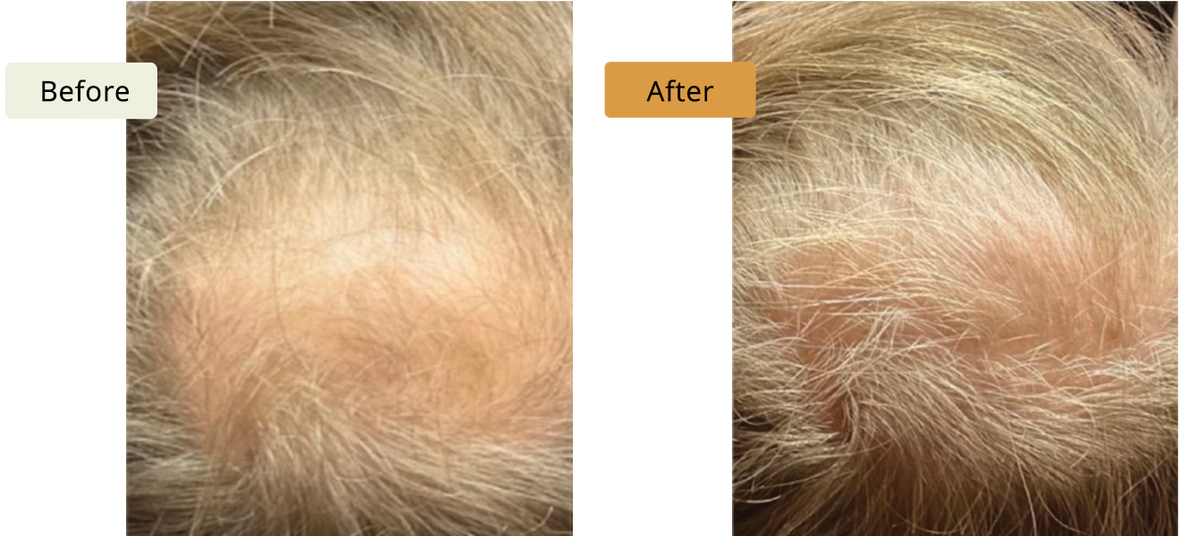 ELE'VI Skin & Medical Aesthetics hair restoration result — Omaha, NE