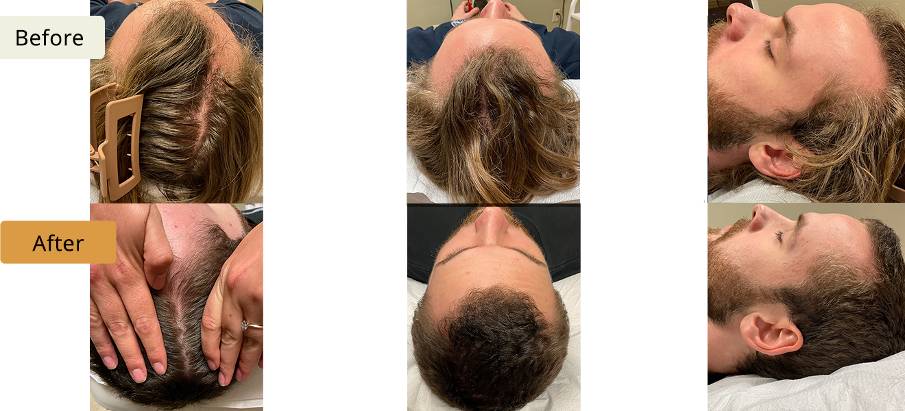 ELE'VI Skin & Medical Aesthetics hair restoration result — Omaha, NE