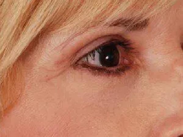 Blepharoplasty after at Advanced Facial Plastic Surgery in Dallas, TX
