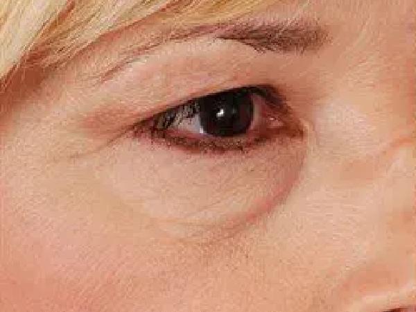 Blepharoplasty before at Advanced Facial Plastic Surgery in Dallas, TX