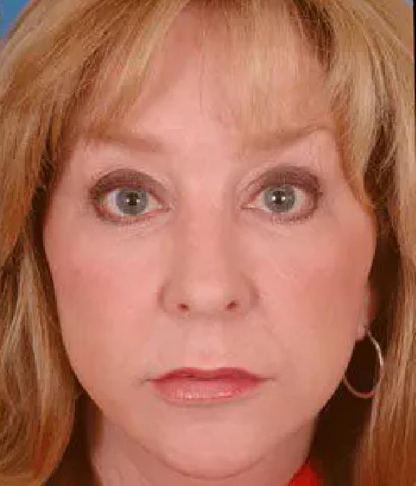Advanced Facial Plastic Surgery facelift after — Dallas, TX