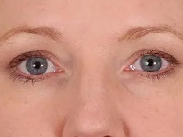 Blepharoplasty after at Advanced Facial Plastic Surgery in Dallas, TX
