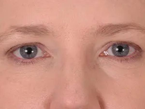 Blepharoplasty before at Advanced Facial Plastic Surgery in Dallas, TX
