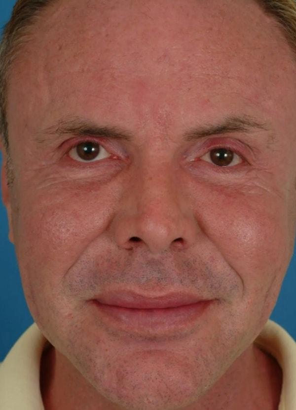 Dermal Fillers after at Advanced Facial Plastic Surgery in Dallas, TX