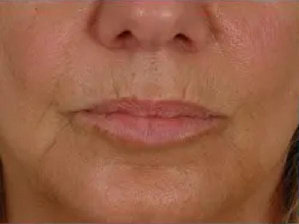 Dermal Fillers before at Advanced Facial Plastic Surgery in Dallas, TX