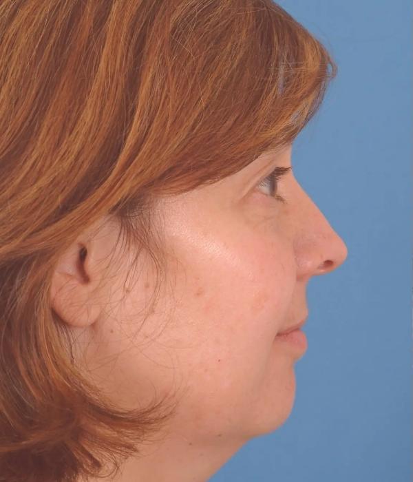 Neck Lift before at Advanced Facial Plastic Surgery in Dallas, TX