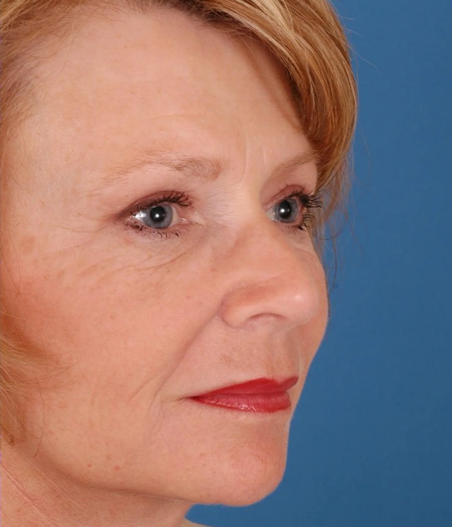 Advanced Facial Plastic Surgery facelift after — Dallas, TX