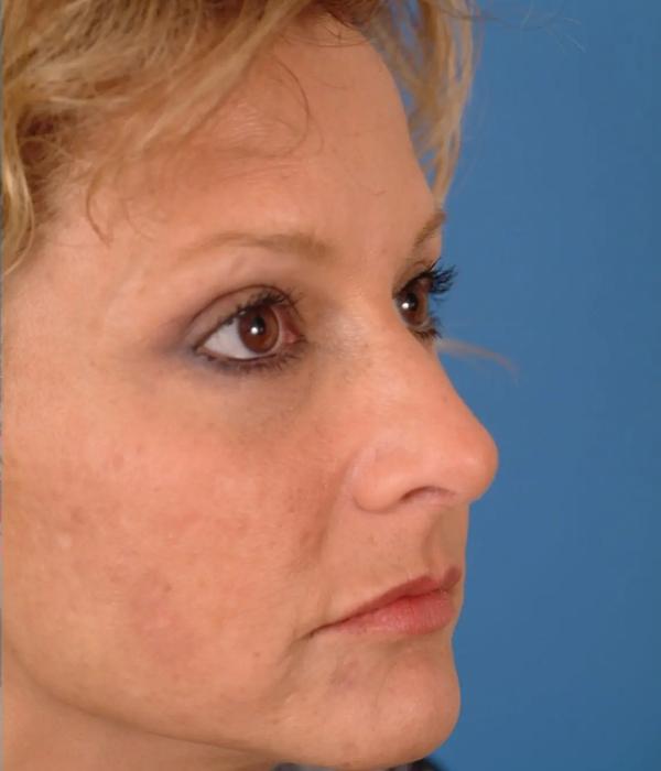 Facelift after at Advanced Facial Plastic Surgery in Dallas, TX