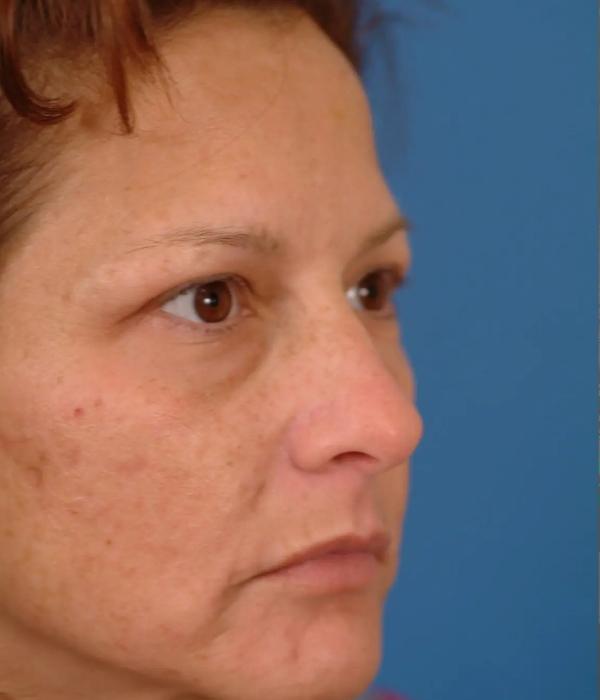 Facelift before at Advanced Facial Plastic Surgery in Dallas, TX