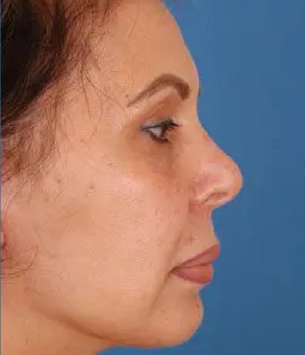 Advanced Facial Plastic Surgery facelift after — Dallas, TX