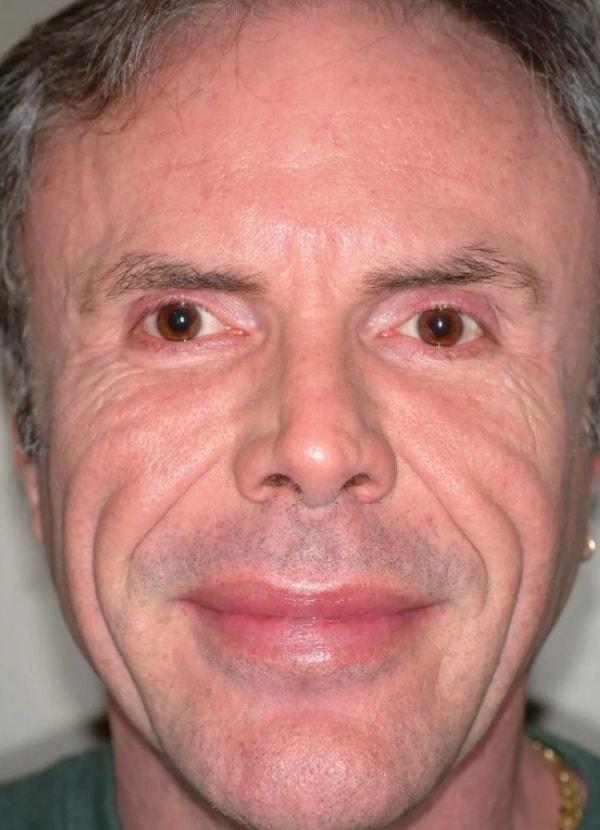 Dermal Fillers before at Advanced Facial Plastic Surgery in Dallas, TX