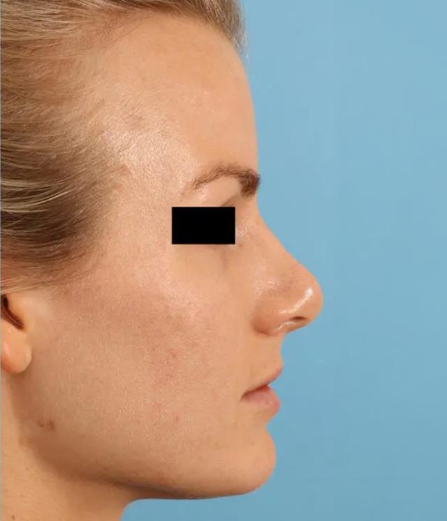 Liquid Rhinoplasty after at Advanced Facial Plastic Surgery in Dallas, TX
