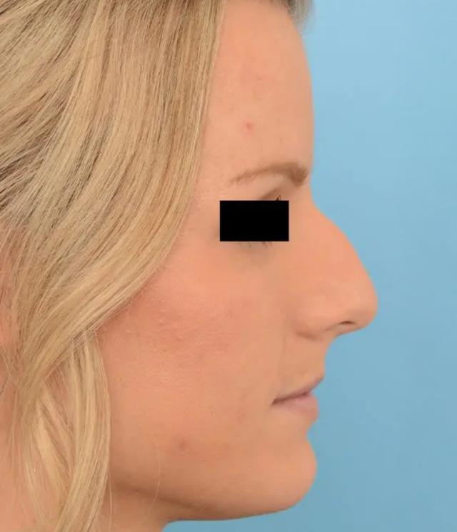 Liquid Rhinoplasty before at Advanced Facial Plastic Surgery in Dallas, TX