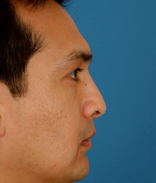 Liquid Rhinoplasty after at Advanced Facial Plastic Surgery in Dallas, TX