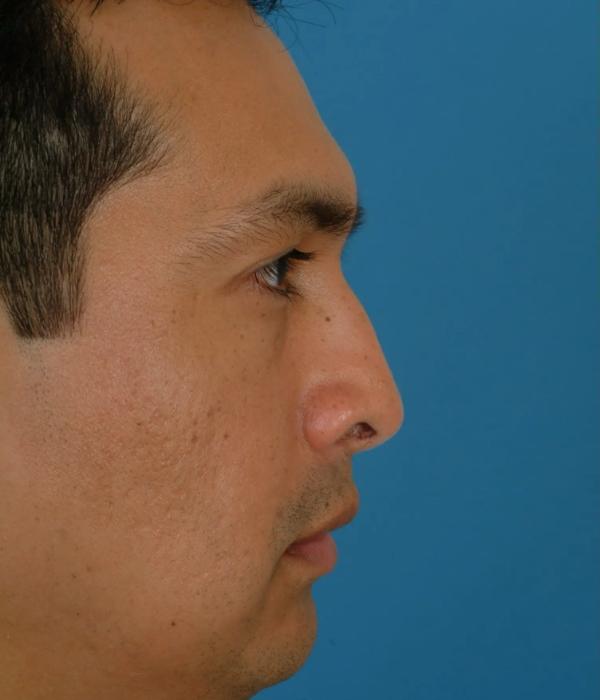 Liquid Rhinoplasty before at Advanced Facial Plastic Surgery in Dallas, TX
