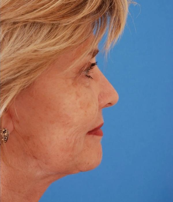 Neck Lift after at Advanced Facial Plastic Surgery in Dallas, TX