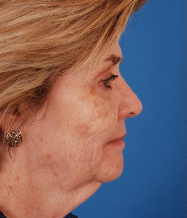 Neck Lift before at Advanced Facial Plastic Surgery in Dallas, TX