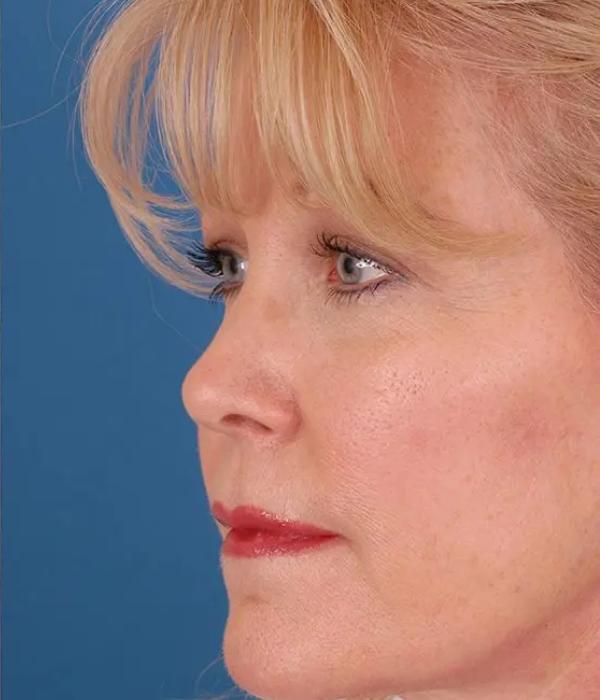 Facelift after at Advanced Facial Plastic Surgery in Dallas, TX
