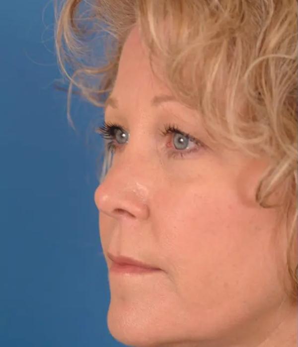 Facelift before at Advanced Facial Plastic Surgery in Dallas, TX
