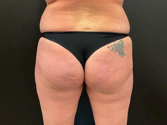 Brazilian Butt Lift before at Après Plastic Surgery in Portland, OR