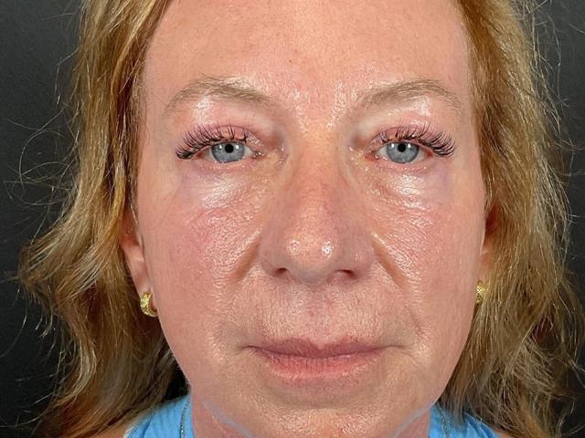 Blepharoplasty after at Après Plastic Surgery in Portland, OR