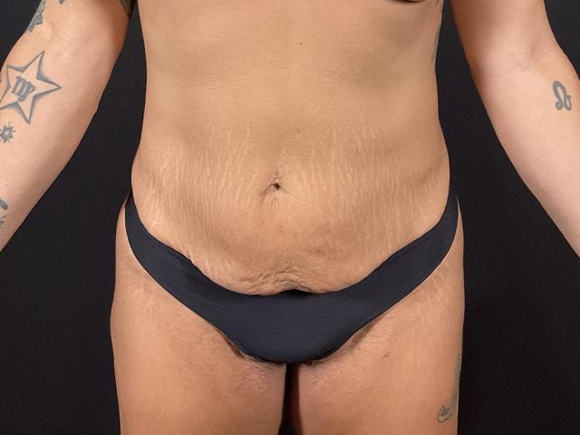 Arm Lift before at Après Plastic Surgery in Portland, OR