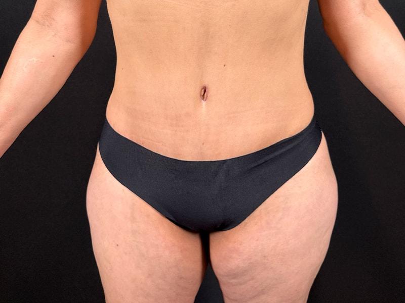 Après Plastic Surgery tummy tuck after — Portland, OR