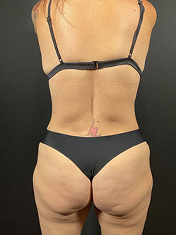 Tummy Tuck after at Après Plastic Surgery in Portland, OR