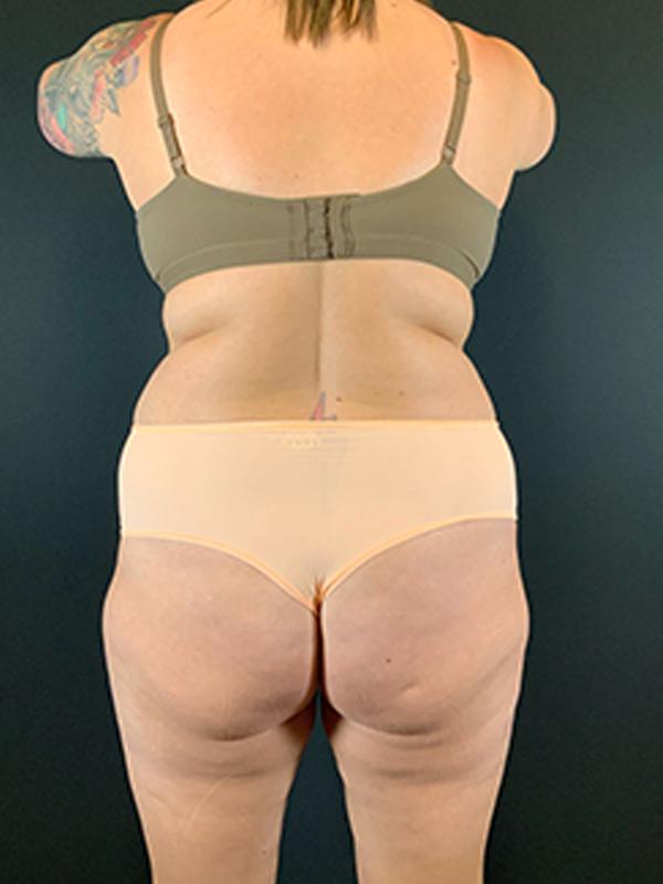 Tummy Tuck before at Après Plastic Surgery in Portland, OR