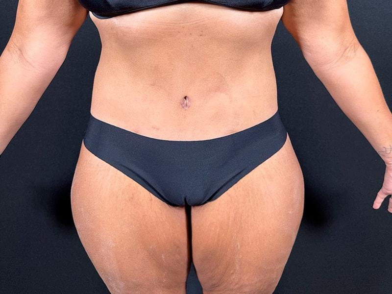Après Plastic Surgery body lift after — Portland, OR