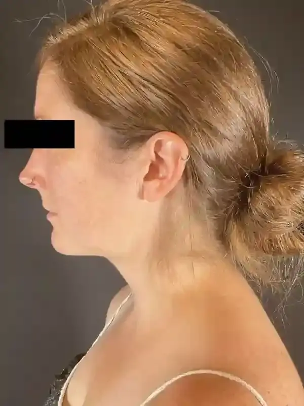 Neck Liposuction after at Après Plastic Surgery in Portland, OR