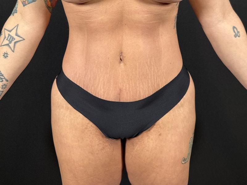 Après Plastic Surgery body lift after — Portland, OR
