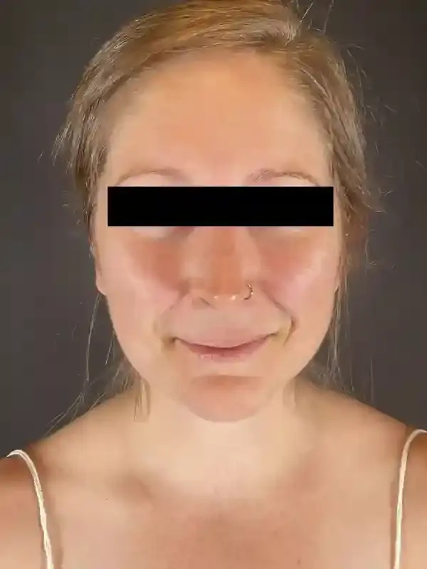 Neck Liposuction after at Après Plastic Surgery in Portland, OR