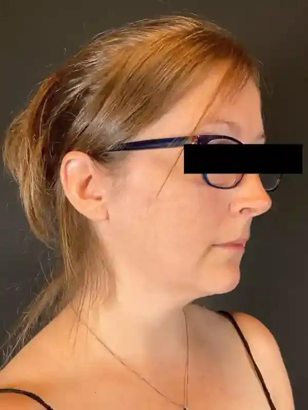 Neck Liposuction before at Après Plastic Surgery in Portland, OR