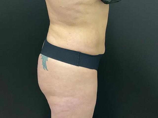 Brazilian Butt Lift after at Après Plastic Surgery in Portland, OR