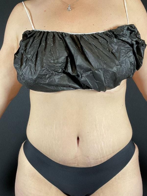 Brazilian Butt Lift after at Après Plastic Surgery in Portland, OR