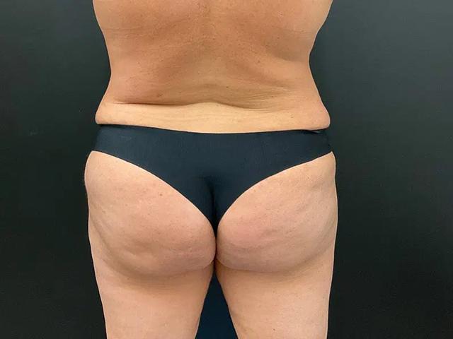 Brazilian Butt Lift after at Après Plastic Surgery in Portland, OR