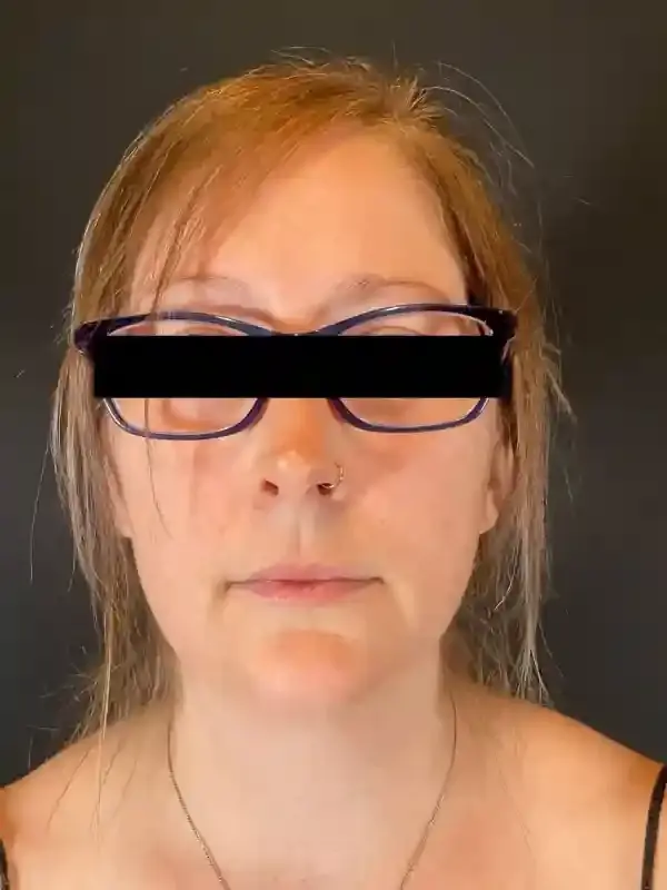 Neck Liposuction before at Après Plastic Surgery in Portland, OR