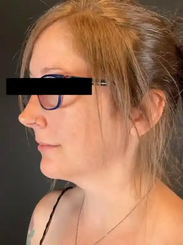 Neck Liposuction before at Après Plastic Surgery in Portland, OR