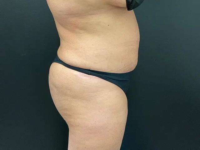 Brazilian Butt Lift after at Après Plastic Surgery in Portland, OR