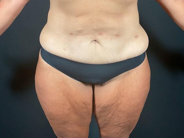 Arm Lift before at Après Plastic Surgery in Portland, OR