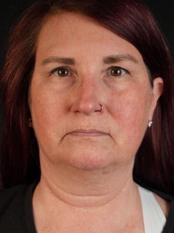 Neck Liposuction before at Après Plastic Surgery in Portland, OR