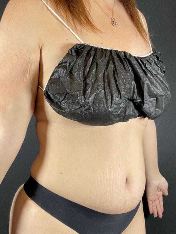 Brazilian Butt Lift after at Après Plastic Surgery in Portland, OR