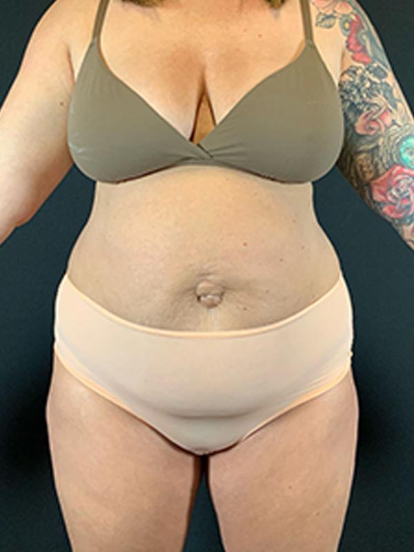Tummy Tuck before at Après Plastic Surgery in Portland, OR
