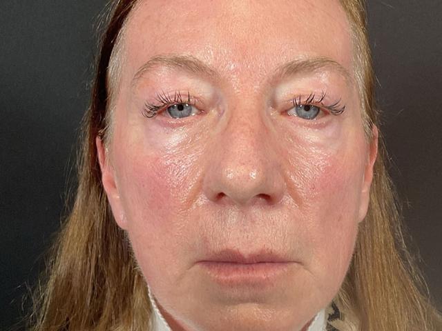 Blepharoplasty before at Après Plastic Surgery in Portland, OR