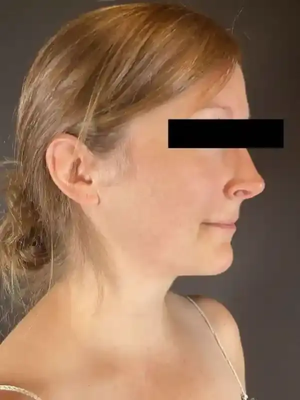 Neck Liposuction after at Après Plastic Surgery in Portland, OR