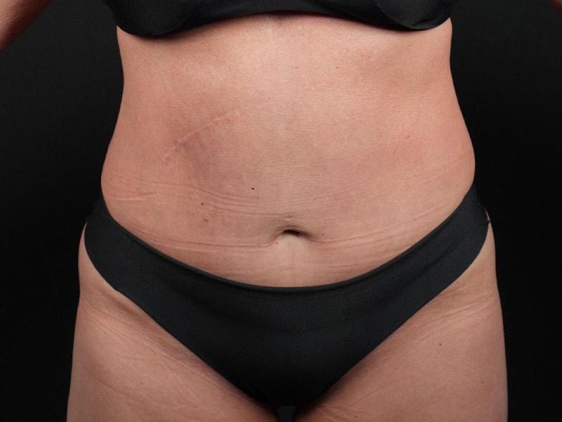 Après Plastic Surgery tummy tuck after — Portland, OR